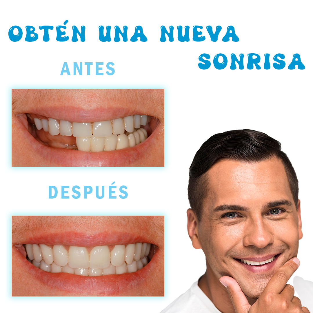 ORIGINAL MOLDATEET®️ ➕ Blanqueador Dental V34 GRATIS - RECUPERA TU SONRISA AL INSTANTE😀