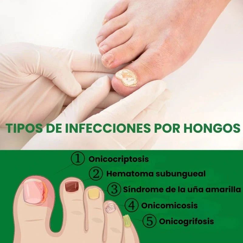 PAGUE 1 Y LLEVE 2 🚚 Serum para Uñas Fuertes, Largas y Sin Hongos💅