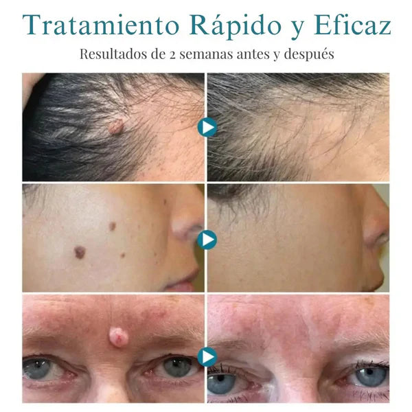 Lápiz Láser para Eliminar Lunares y Verrugas ➕ Envío Gratis