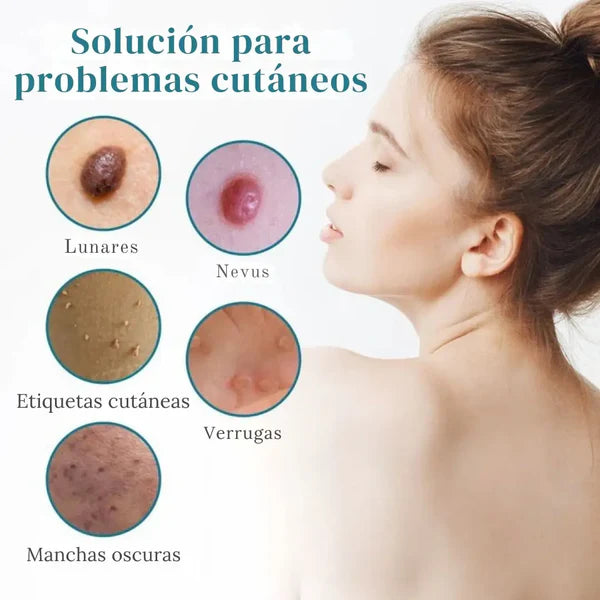 Lápiz Láser para Eliminar Lunares y Verrugas ➕ Envío Gratis