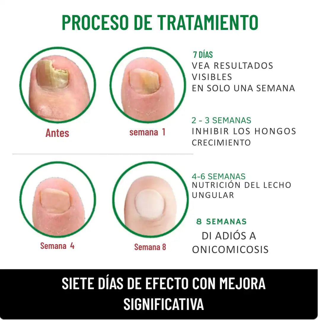 PAGUE 1 Y LLEVE 2 🚚 Serum para Uñas Fuertes, Largas y Sin Hongos💅